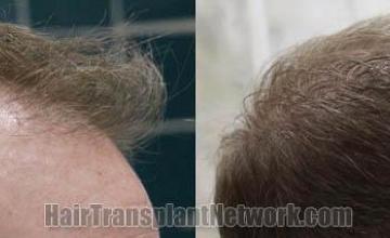 Hair transplantation surgery before and after images