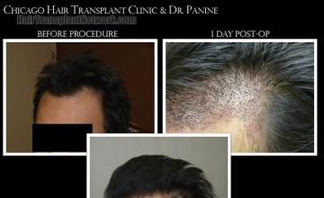 Hair transplantation surgery before and after images