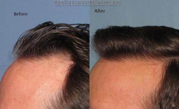 Hair transplantation surgery before and after pictures