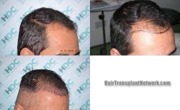 Hair transplantation surgery before and after images