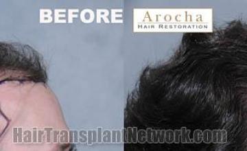 Hair transplantation surgery before and after images