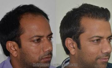 Hair transplantation surgery before and after photos