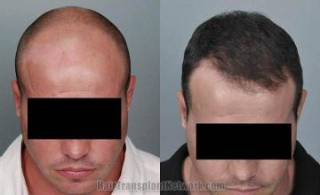 Hair restoration surgery before and after photos