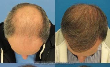 Top view before and after hair restoration procedure