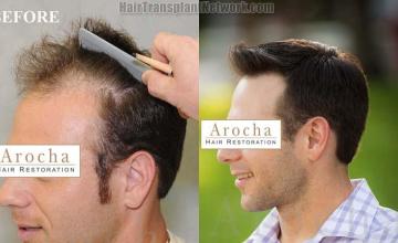 Hair transplantation surgery before and after pictures