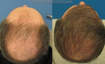 Back / Crown view hair transplant results