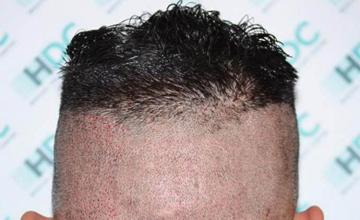 Hair restoration procedure before and after pictures