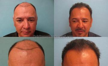 Hair transplantation surgery before and after photos