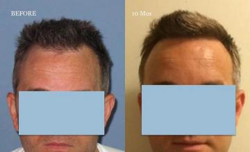 Hair restoration procedure before and after results