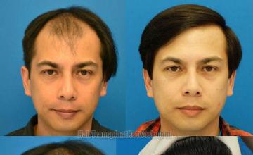 Before and after surgical hair restoration images