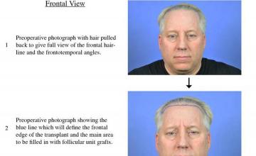 Hair restoration procedure before and after results