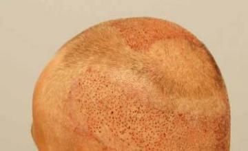 Hair transplantation surgery before and after pictures