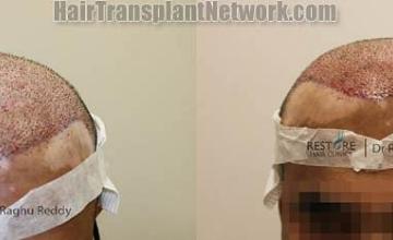 Hair transplantation surgery before and after pictures