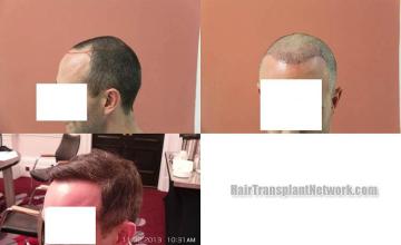 Hair restoration procedure before and after pictures