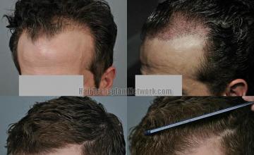 Hair transplantation surgery before and after pictures