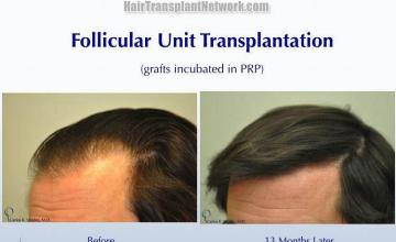 Hair transplantation surgery before and after pictures