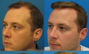 Surgical hair transplantation result photographs