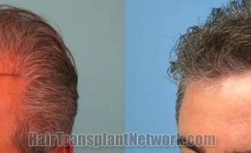 Hair restoration procedure before and after pictures