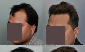 Hair restoration procedure before and after pictures