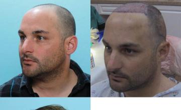 Hair transplantation surgery before and after pictures
