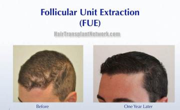 Hair transplantation surgery before and after images