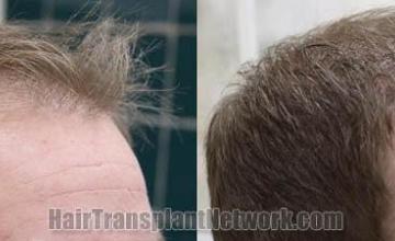 Hair transplantation surgery before and after photos