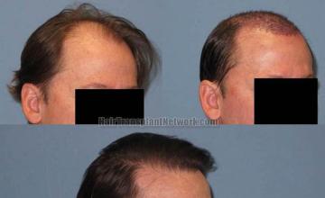 Hair transplantation surgery before and after images