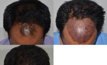 Hair transplantation surgery before and after photos