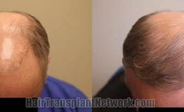 Hair transplantation surgery before and after photos