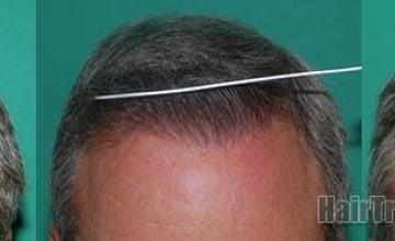 Before and after hair transplantation photos