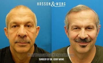 Hair restoration procedure before and after results