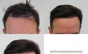 Before and after hair restoration procedure images