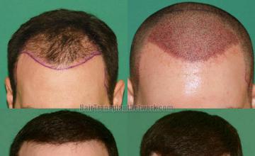 Front view - Before and after hair restoration procedure