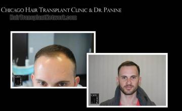 Front view - Before and after hair restoration procedure