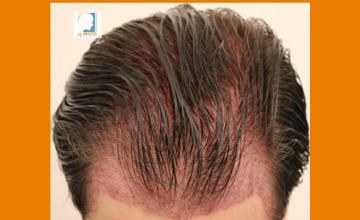 Hair restoration surgery before and after images