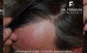 Closeup views of hairline and donor area after hair restoration