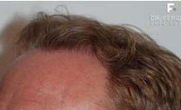 Hair restoration procedure before and after pictures