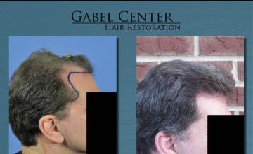 Right view photographs before and after hair restoration