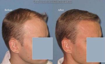 Hair restoration procedure before and after results