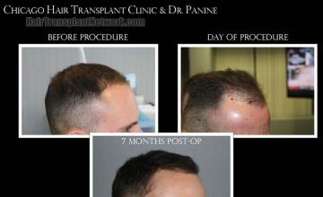 Hair transplantation procedure before and after results