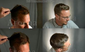 Hair transplantation procedure before and after results