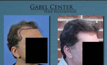 Right oblique view before and after hair restoration 