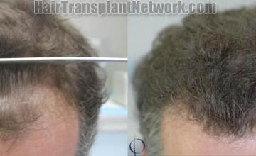 Hair restoration procedure before and after results