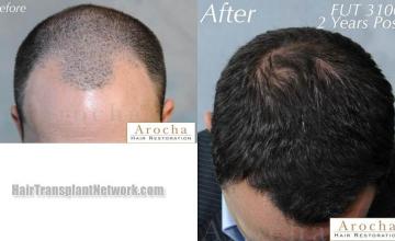 Hair transplantation surgery before and after photos