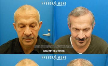 Hair transplantation surgery before and after photos