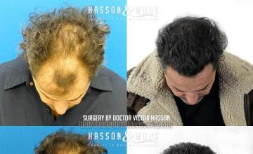 Hair transplantation surgery before and after images