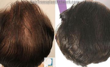 Hair transplantation surgery before and after images