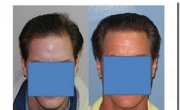 Hair restoration procedure results