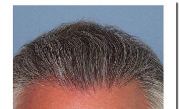 Hair restoration procedure results