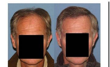 Hair restoration procedure results